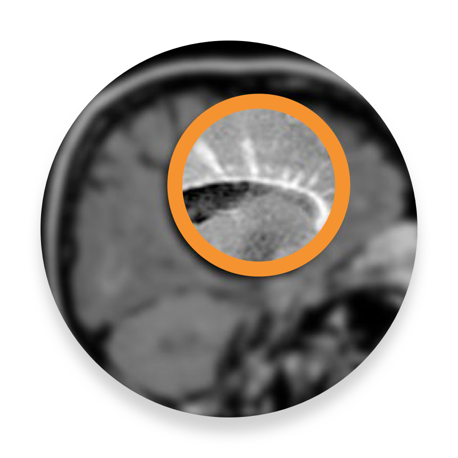 Scan of a brain lesion